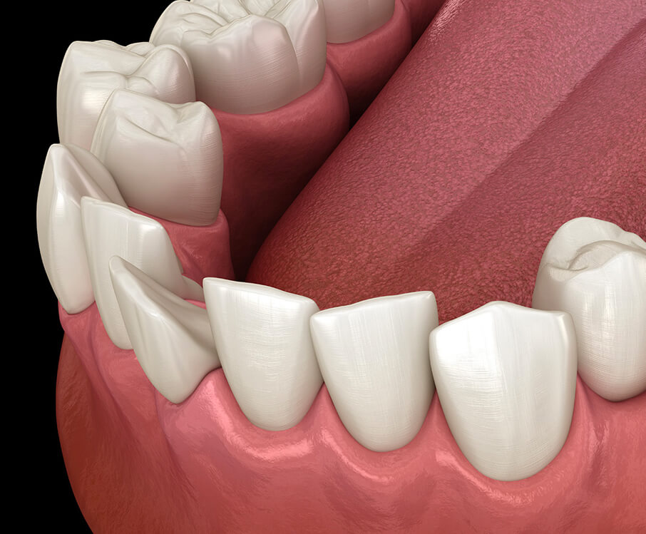 illustration of a gum line