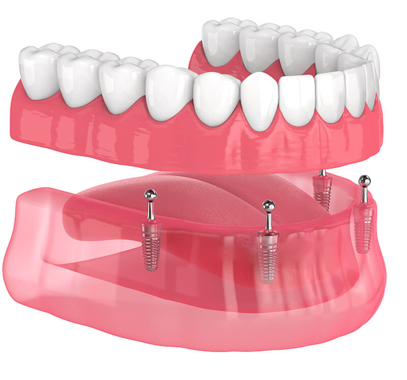 illustration of a dental implant procedure