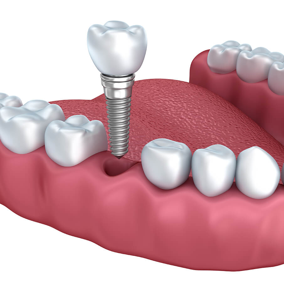 illustration of a dental implant procedure