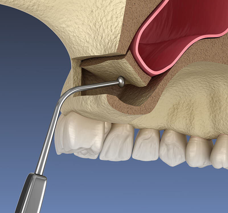 illustration of a dental implant procedure