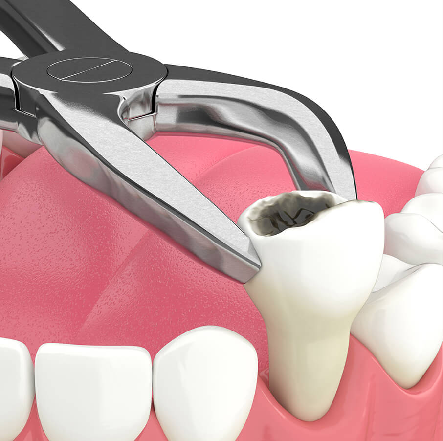 illustration of a dental implant procedure