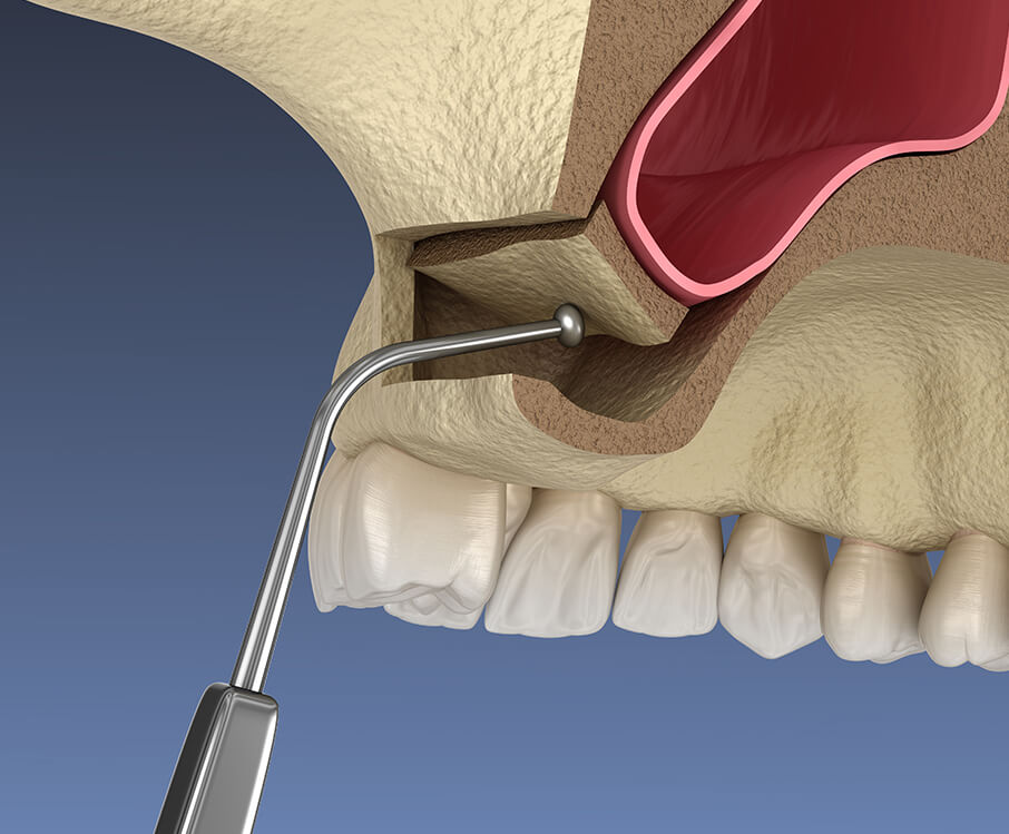 illustration of a sinus lift procedure