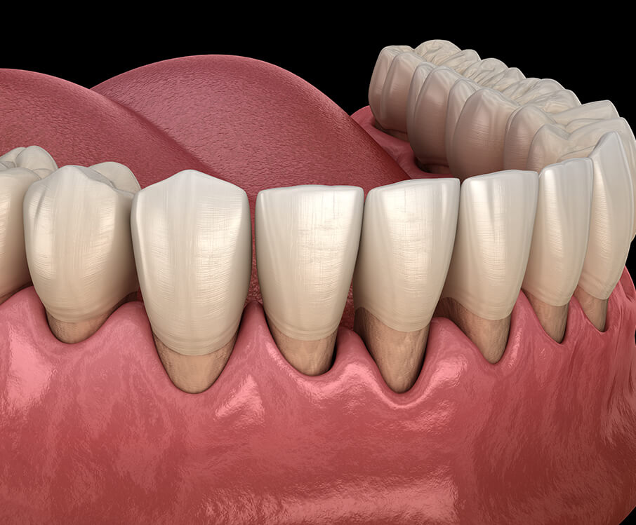 illustration of gum recession