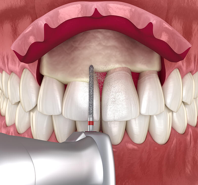 illustration of crown lengthening