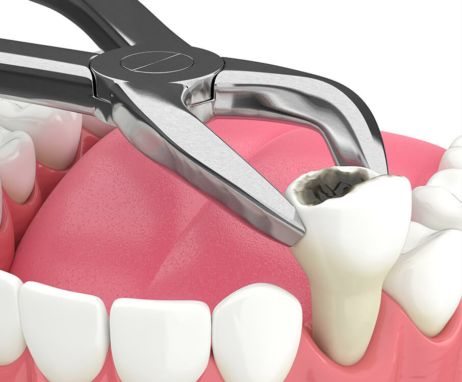 illustration of a dental extraction