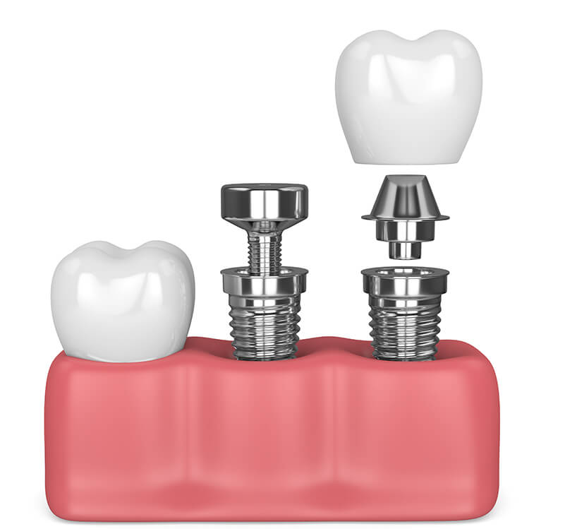 illustration of a dental implant