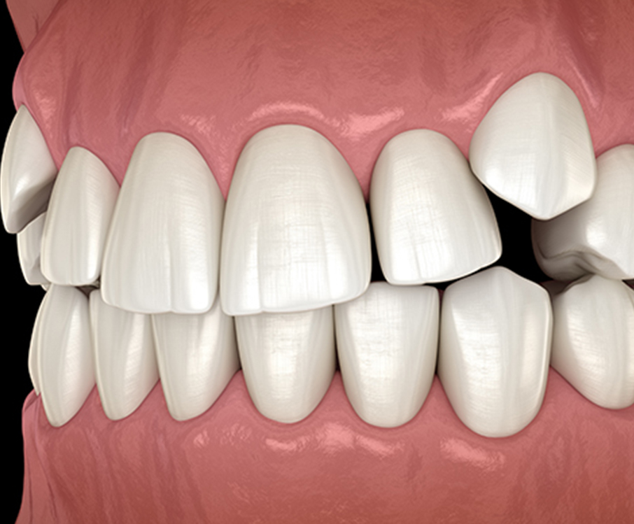 illustration of an impacted tooth