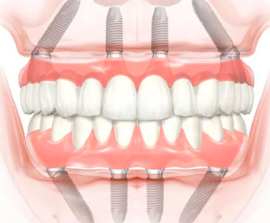 illustration of All-on-4 dental implants