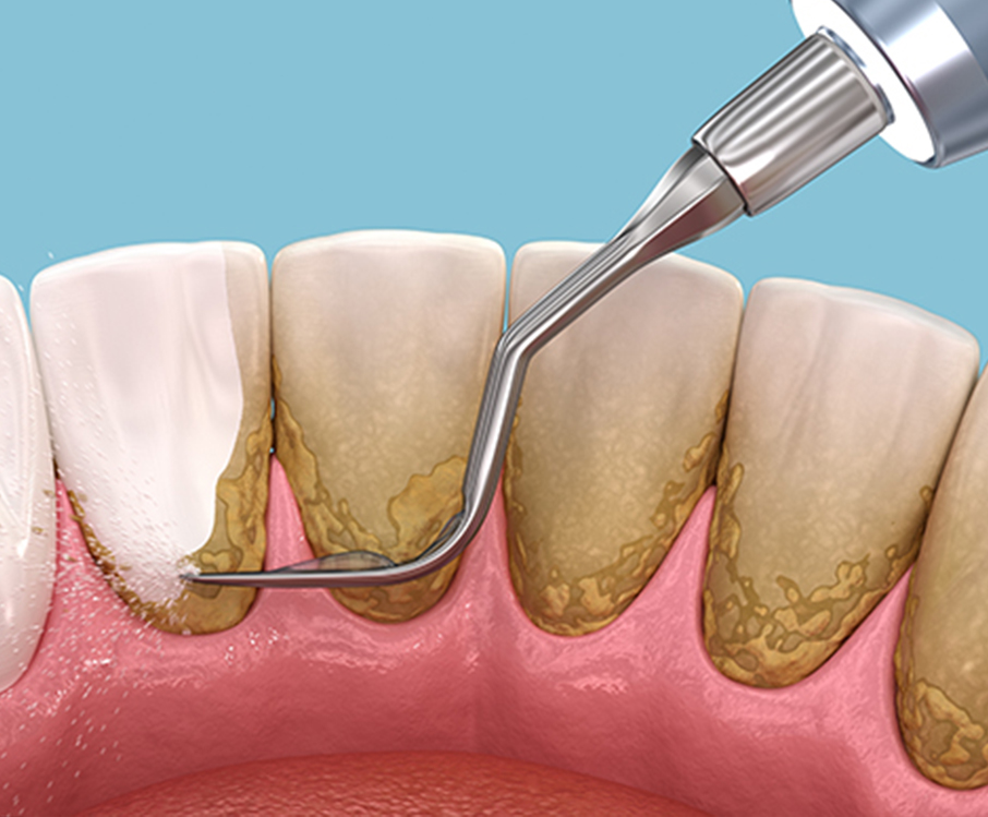 illustration of periodontal disease treatment